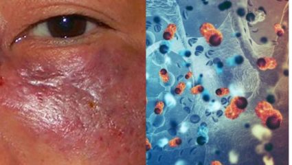 Mucormycosis ची औषधं अल्पदरात उपलब्ध करून द्या; उच्च न्यायालयाचे निर्देश