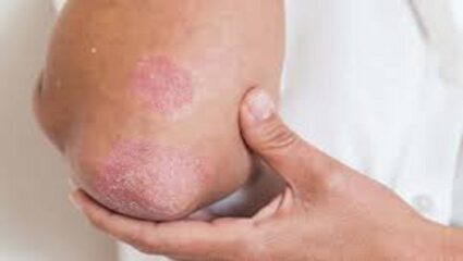 फंगल इन्फोक्शन झाल्यास ही काळजी घ्या…