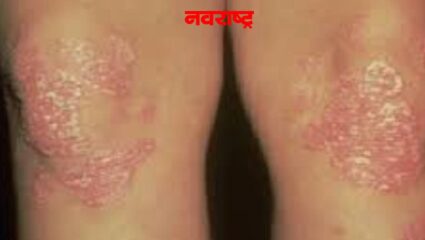सोरायसिस लक्षणे आणि कारणे काय ते जाणून घ्या