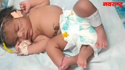 अबब! मध्यप्रदेश 4 पाय असलेल्या बालकाला महिलेने दिला जन्म; बाळ सध्या Special Newborn Care Unit मध्ये