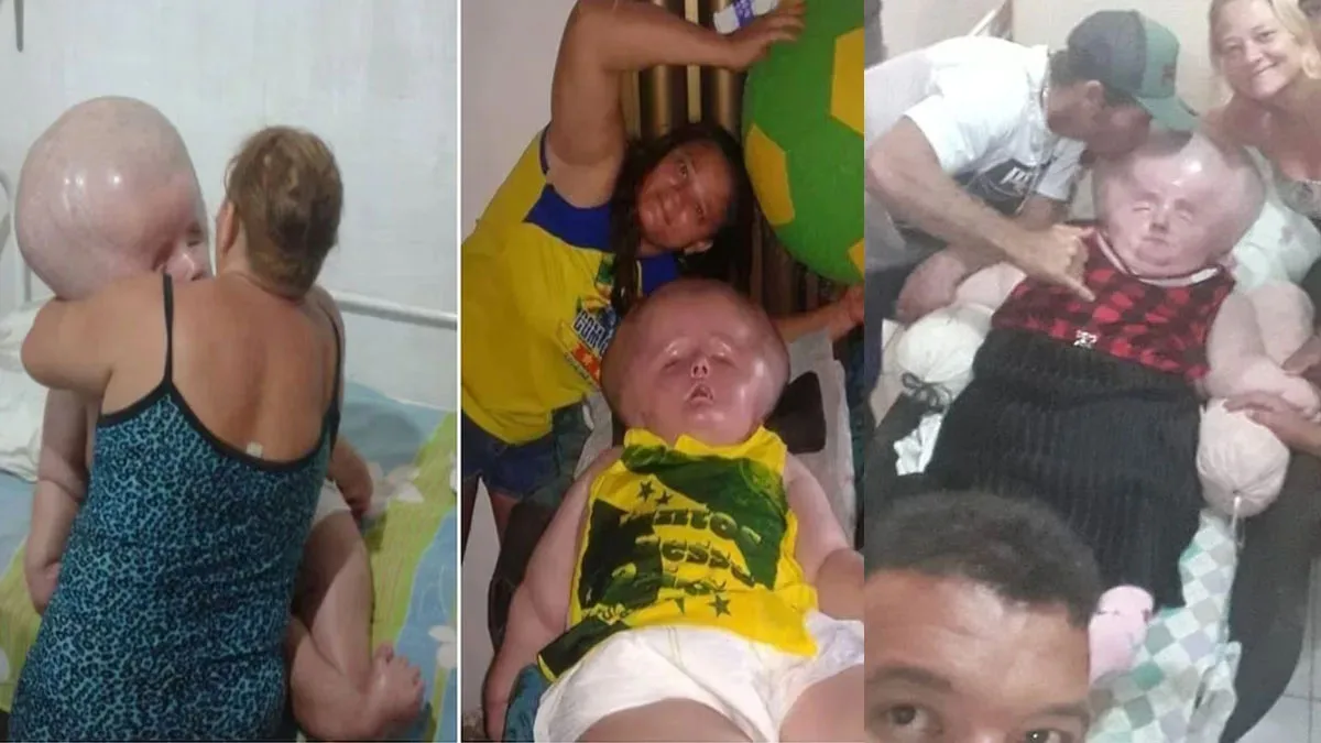 काय सांगता? तिच्या मुलीच्या डोक्याचा आकार दिवसेंदिवस वाढतोय, चालणं, बोलणं आणि बघायलाही होतोय त्रास, वाचा एका आईची वेदनादायी कहाणी