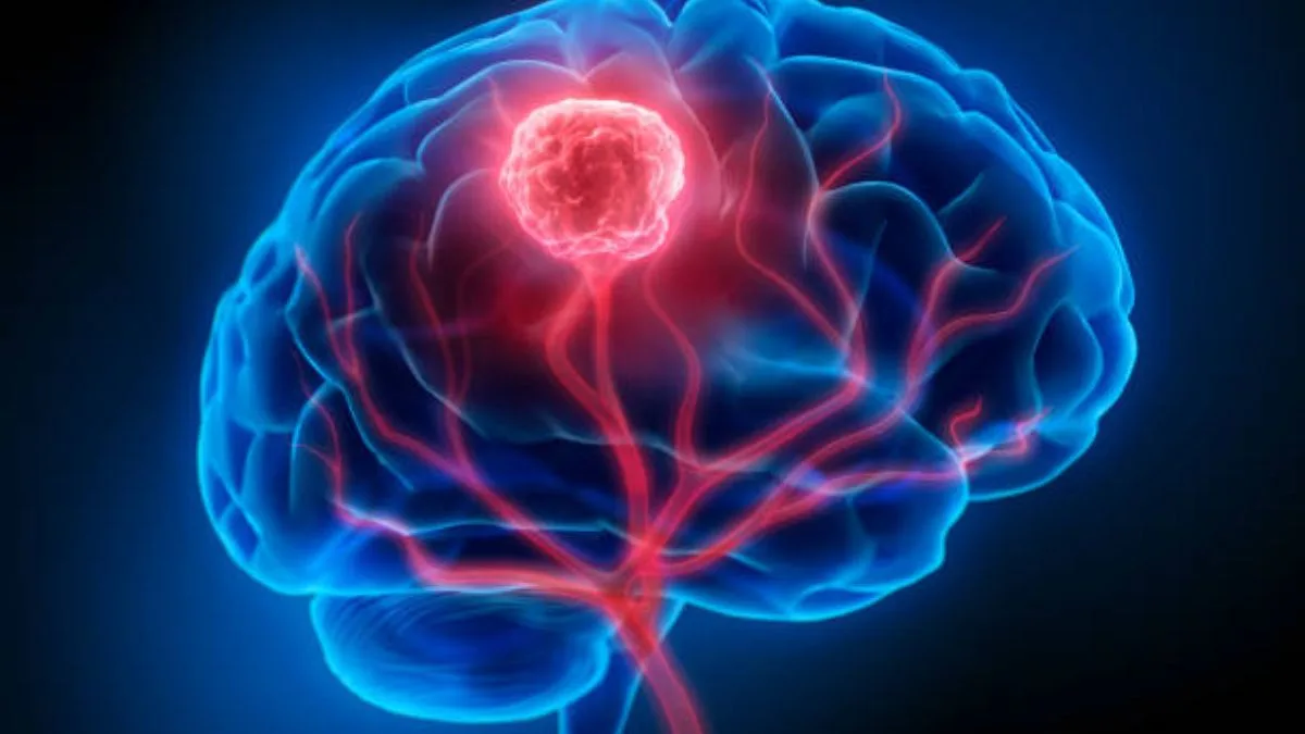 ब्रेन ट्युमरची लक्षणे दिसू लागल्यास कसे करावे औषध उपचार, जाणून घ्या तज्ज्ञांचा सल्ला