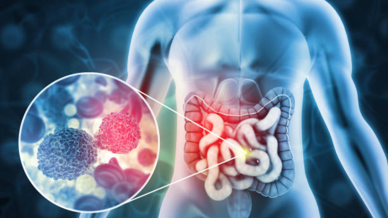 किडनी कॅन्सरची कारणे (फोटो सौजन्य - iStock)