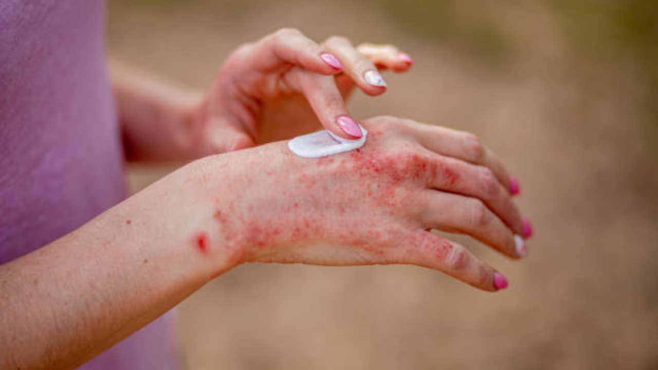 सोसायसिस असल्यास काय करावे