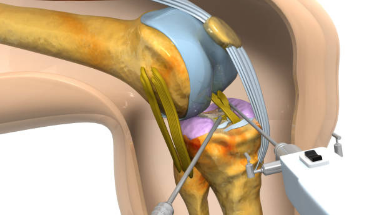 गुडघ्याची शस्त्रक्रिया कधी करावी