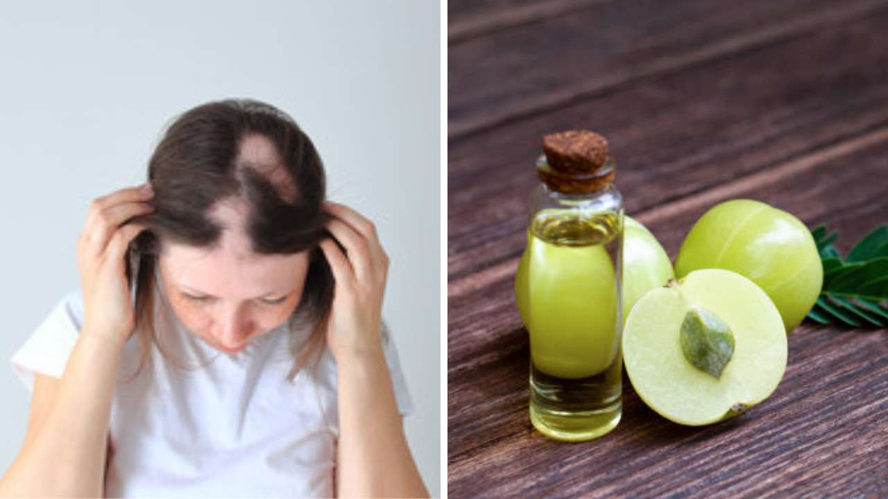 टक्कल पडतंय का? घरीच बनवा आवळ्याचं तेल, 1 महिन्यात वाढतील केस