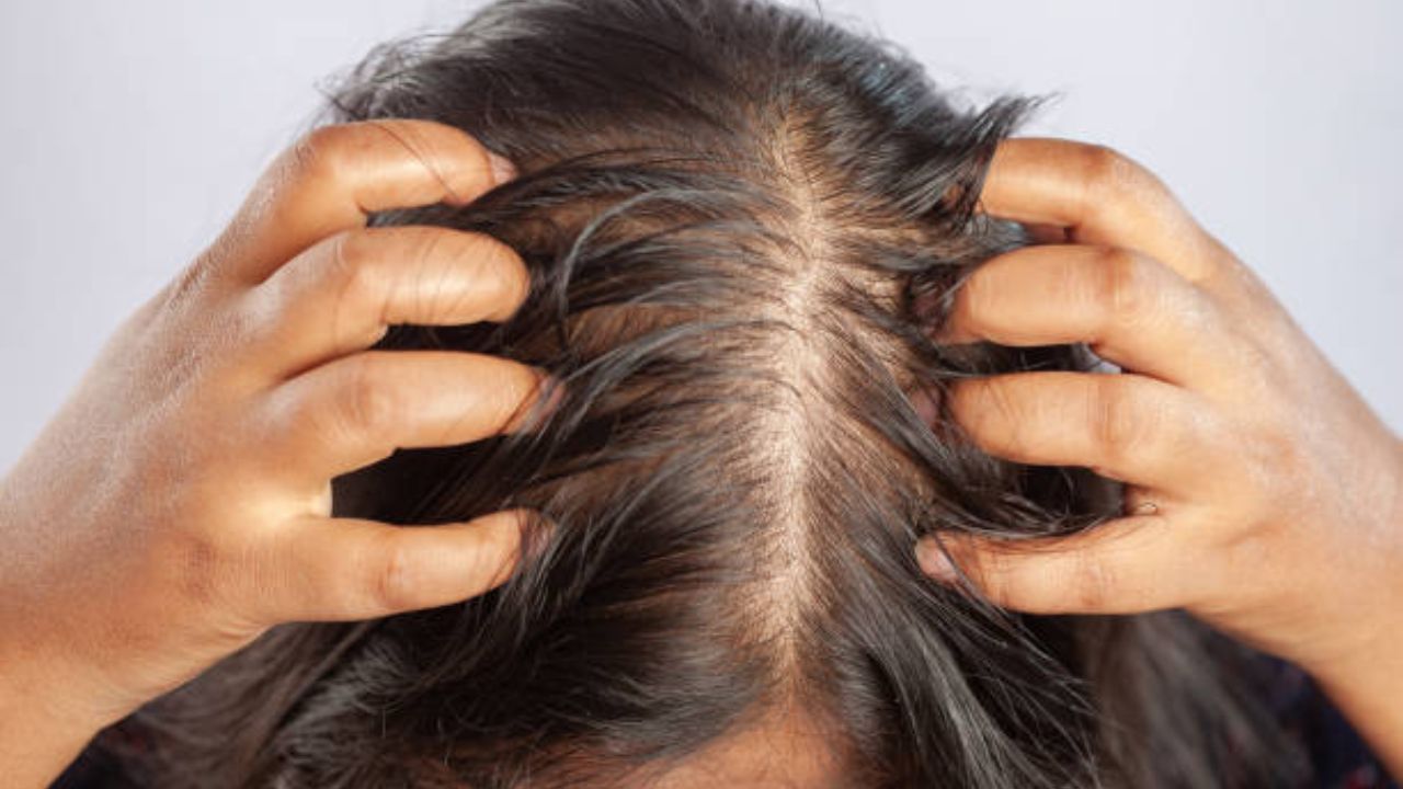 हे उपाय केल्याने केसांना खाज नाही सुटणार (फोटो सौजन्य: iStock)