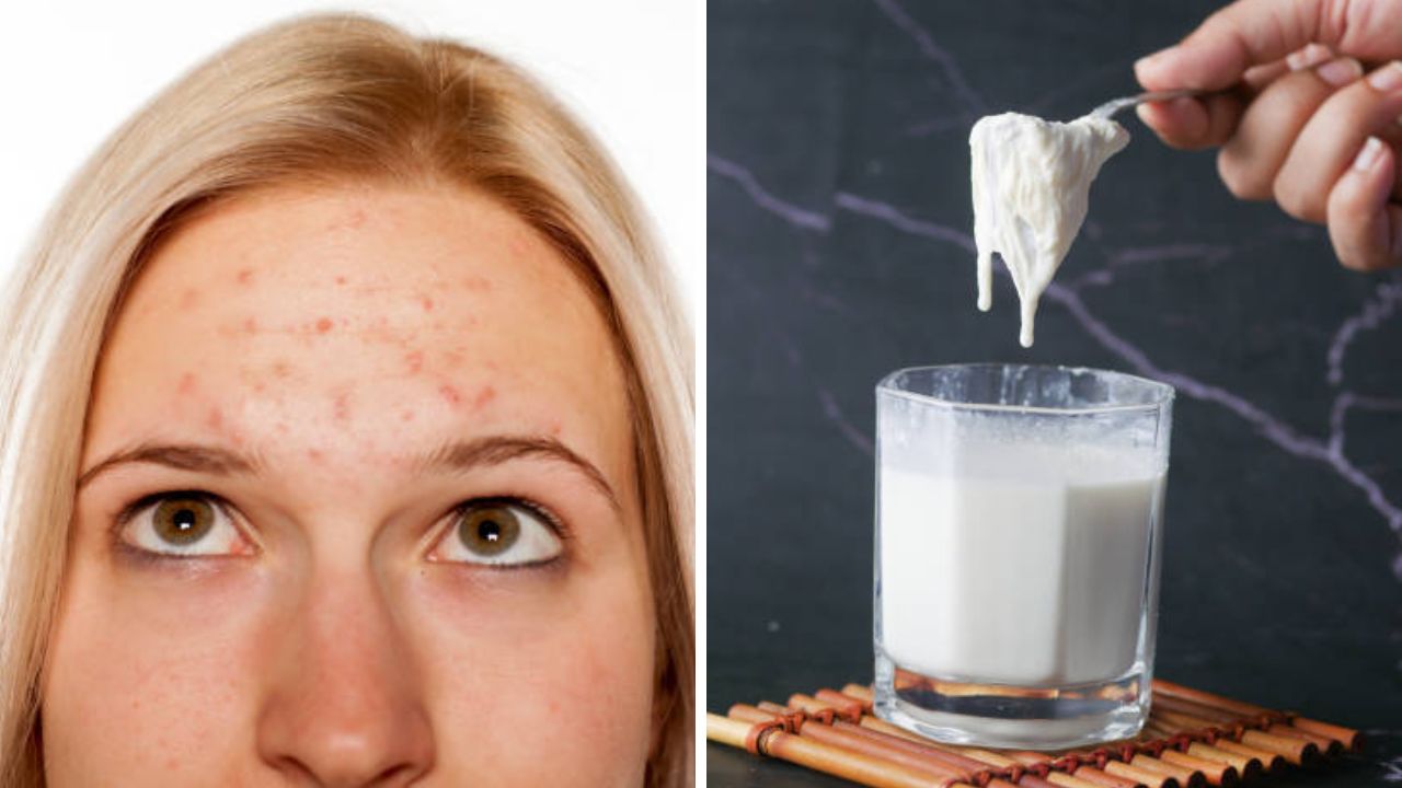 कपाळावरील काळेपणा घालवण्यासाठी घरगुती उपाय