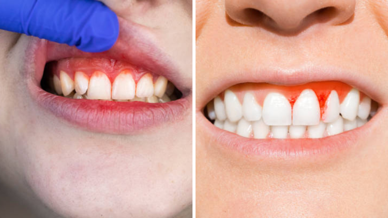 हिवाळ्यात जीव घेऊ शकते दात आणि हिरड्यांमधील त्रास, 5 उपायांनी मिळवा पटकन सुटका