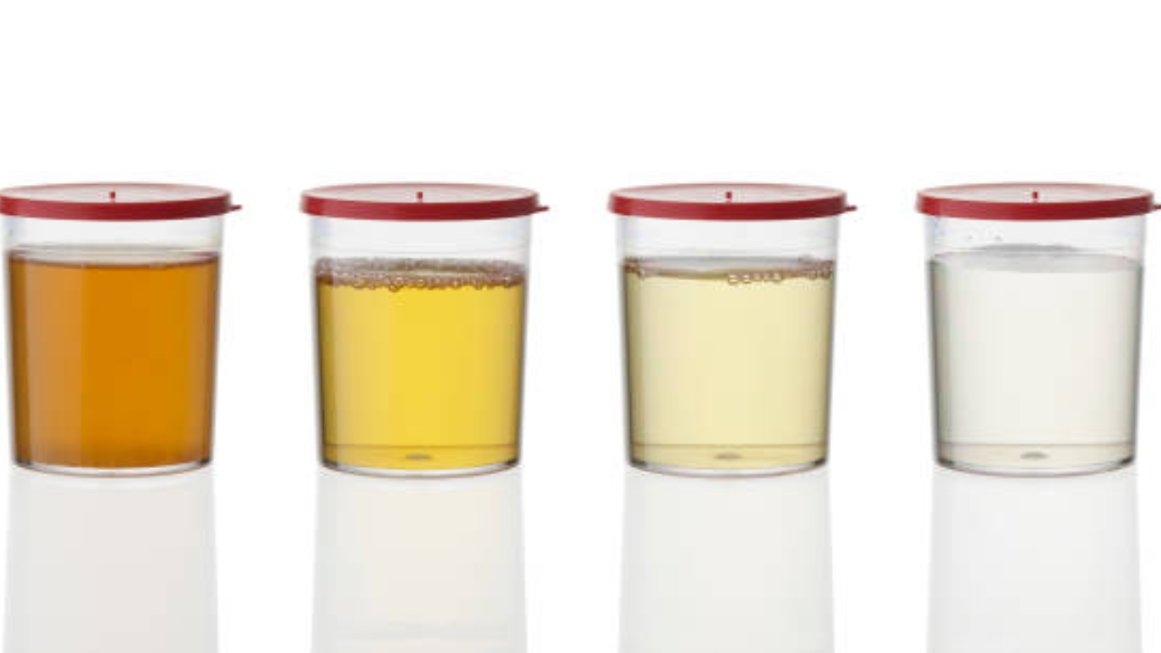 कधीकधी लघवीचा रंग ढगासारखा ढगाळ होतो, हे गंभीर संसर्ग दर्शवते, तुमच्या मूत्राशयात काही प्रकारचे संसर्ग होण्याची शक्यता असते, अशा परिस्थितीत तुम्ही ताबडतोब डॉक्टरकडे जावे