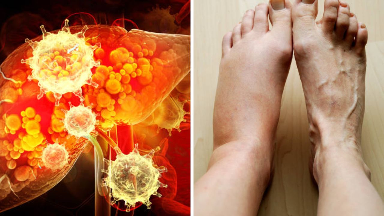 Health News : पायांना सतत सूज येते? लिव्हर कायमचे निकामी झाल्यानंतर पायांमध्ये दिसू लागतात ‘ही’ भयानक लक्षणे