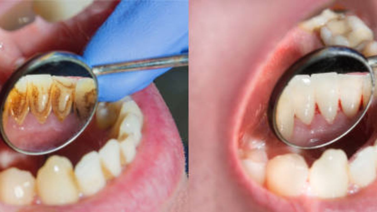 दातांची सफाई कशी करावी