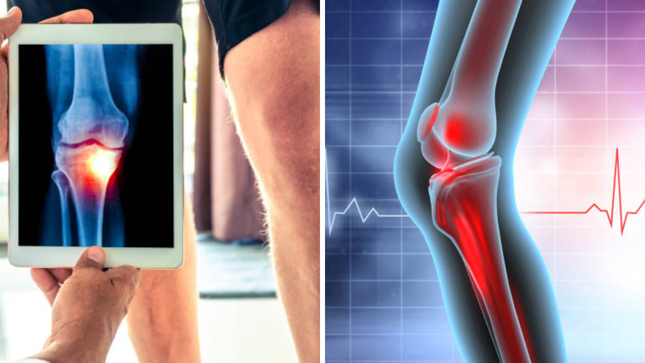 गुडघ्याच्या दुखापतींचे प्रकार (फोटो सौजन्य - iStock)