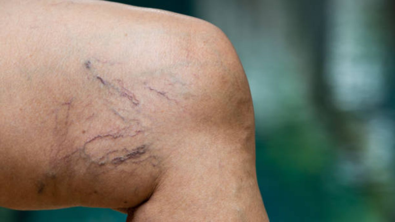 Leg Vein Blockage: पायांच्या नसा ब्लॉक झाल्या आहेत? मग ‘हे’ सोपे उपाय करून तात्काळ मिळावा आराम, नसांमधील रक्तप्रवाह होईल सुरळीत