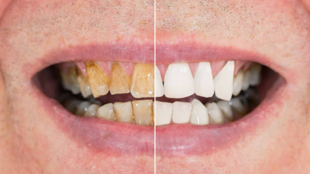 पिवळ्या दातांवरील योग्य घरगुती उपाय 