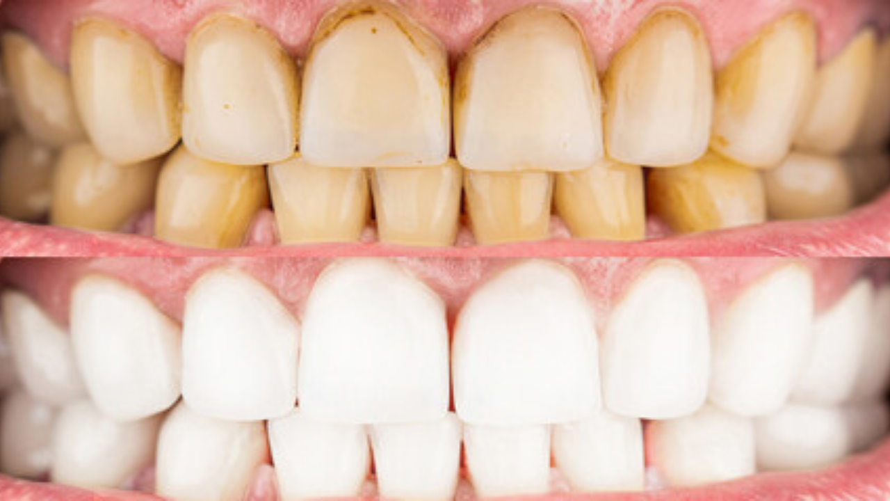 केमिकलशिवाय सफेद होतील पिवळसर दात, ‘या’ फळाचे साल काढेल दातावरील पिवळा थर खेचून बाहेर