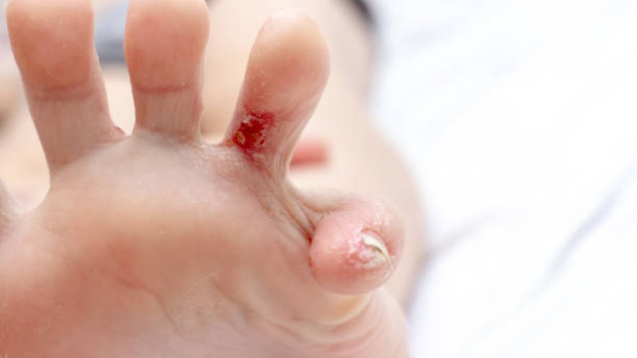 Foot Fungus: पावसाळ्यात पायांना सतत बुरशी येते? जाणून घ्या पायांवरील बुरशी टाळण्यासाठी प्रभावी उपाय