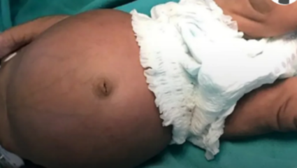 नवजात बाळाच्या पोटात बाळ! जगात फार दुर्मिळ असणारी ‘ही’ कंडिशन आहे तरी काय? जाणून घ्या