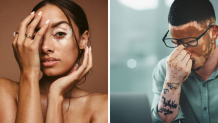 World Vitiligo Day: विटिलिगोबाबत गैरसमज, जागरुकता महत्त्वाची; संसर्गजन्य आजार नाही तर…