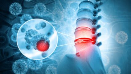 ही 5 लक्षणे दिसताच समजून जा तुम्हाला झालाय Bone Cancer; वेळीच लक्ष दिले नाही तर भोगावे लागतील वाईट परिणाम