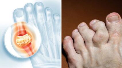 Uric Acid वाढल्यानंतर शरीरात दिसून येतात ‘हे’ बदल, दुर्लक्ष केल्यास उद्भवेल संधिवाताची समस्या