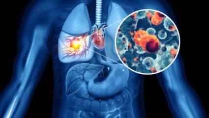 Lung Cancer: फुफ्फुसांचा कर्करोग झाल्यानंतर शरीरात दिसून येतात ‘ही’ गंभीर लक्षणे, दुर्लक्ष केल्यास उद्भवेल मृत्यू