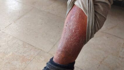 पावसाळ्याच्या दिवसांमध्ये का वाढतो पायांच्या गँगरीनचा धोका? जाणून घ्या लक्षणे आणि पाय स्वच्छ ठेवण्यासाठी उपाय