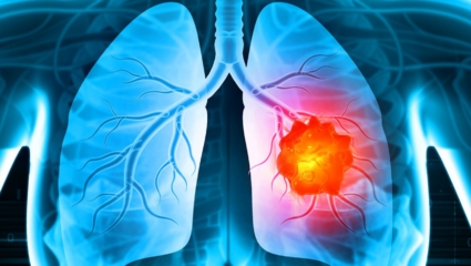 तरुणांमध्ये झपाट्याने वाढत आहे Lung Cancer चा धोका; वेळीच जाणून घ्या लक्षणं आणि कारणे