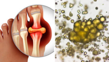 Uric Acid कसे कराल कमी? 5 पदार्थ आताच करा सुरू, शरीरातून फेकतील सडलेली घाण