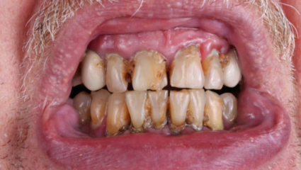 Yellow Teeth Home Remedies: पिवळे दात ठरतायत लाजेचं कारण, टूथपेस्टच्या ठिकाणी वापरा 4 देशी जुगाड, मनसोक्त हसा