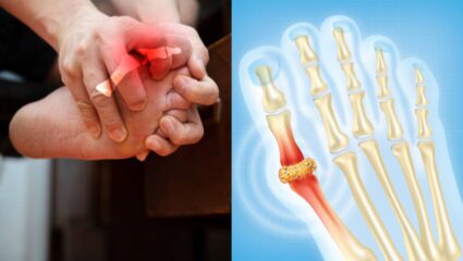 युरिक अ‍ॅसिड बोटांमध्ये जमा करते दगड; डॉक्तरांनी सांगितले ४ प्रभावी उपाय ज्याने क्षणातच सर्व कचरा पडेल बाहेर