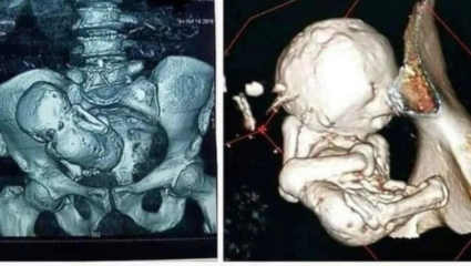 40 वर्ष पोटात ‘दगडाचं मूल’ घेऊन फिरत होती महिला, रिपोर्ट वाचून डोकंच फुटेल; काय आहे नेमका आजार