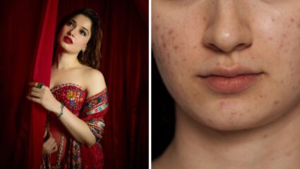 मुरुमं घालविण्यासाठी Tamannaah Bhatia वापरते स्वतःची थुंकी, तज्ज्ञांनी सांगितले तथ्य