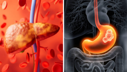 Fatty Liver मुळे वाढतोय लिव्हर Cancer चा धोका, बाबा रामदेव यांनी दिला उपाय; वेळीच व्हा सावध!