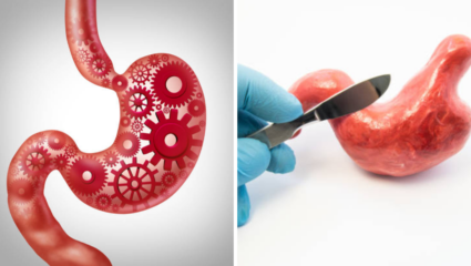 Gastroparesis Awareness Month: ॲसिडिटी किंवा अपचन समजून ५०% महिला आणि मधुमेही गॅस्ट्रोपेरेसिसकडे करताय दुर्लक्ष