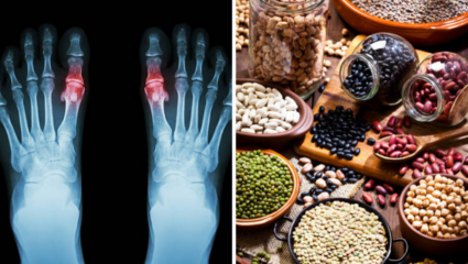 High Uric Acid रूग्णांसाठी ‘कर्दनकाळ’ ठरतात 5 डाळी, आजच खायचे सोडून द्या