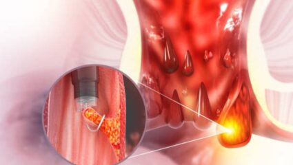 मूळव्याधामुळे रक्तस्राव जास्त होतो, थांबविण्यासाठी काय करावे