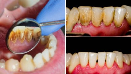 Teeth Whitening: पिवळे दात सफेद करण्याचे घरगुती उपाय, 2 मिनिटात होईल Plaque टार्टरची स्वच्छता