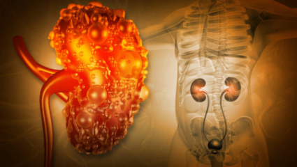 शरीरात पसरतंय विषारी Creatinine, 8 पद्धतीने निघेल कचरा; कुजण्यापासून वाचेल किडनीची चाळण