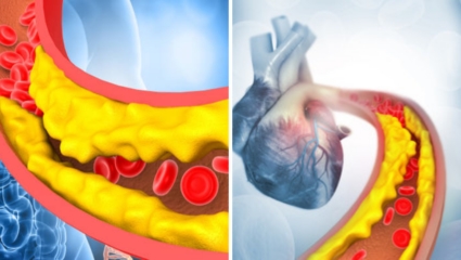 High LDL कोलेस्टेरॉलवरील उपचार, निरोगी हृदयासाठी योग्य मार्गदर्शन; तज्ज्ञांनी दिले प्रभावी उपाय