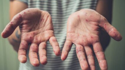 Hand Foot Mouth Disease म्हणजे काय? नव्या आजाराची लागण झाल्यानंतर शरीरात दिसून येतात ‘ही’ गंभीर लक्षणे