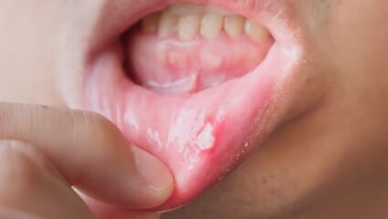 तोंडात वाढलेल्या जखमा- अल्सर एका रात्रीत बरे! ‘या’ पदार्थांच्या सेवनामुळे विटामिन बी १२ ची कमतरता होईल दूर