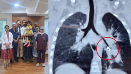 बापरे! साडेतीन वर्षांच्या मुलाच्या फुफ्फुसातून बाहेर काढला LED बल्ब! जसलोक रुग्णालयातील घटना