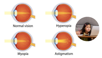 Myopia विषयीचे सर्वसामान्य गैरसमज, वेळीच करा दूर; काय आहे सत्य