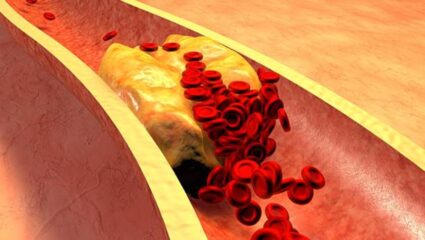 वेगाने वाढत चाललंय शरीरातलं High Cholesterol? विषारी घाणेरडं कोलेस्ट्रॉल क्षणात पडेल बाहेर, फक्त या देसी पदार्थांचे सेवन करा