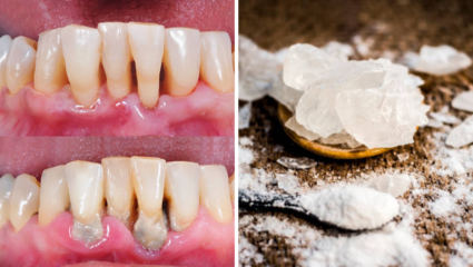 Teeth Home Remedies: दातांचा पिवळेपणा कसा काढावा? आयुर्वेदिक डॉक्टरने सांगितले ओरल हेल्थसाठी वापरा किचनमधील ‘हा’ पदार्थ