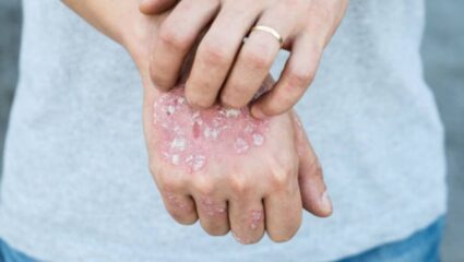World Psoriasis Day: स्किन सोरायसिस झाल्यानंतर दिसून येतात ‘ही’ गंभीर लक्षणे, योग्य उपचार पद्धतीने मिळेल आराम