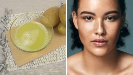 पिगमेंटेशनमुळे चेहरा काळा पडला आहे? मग ‘या’ पद्धतीने करा बटाट्याचा वापर, त्वचेच्या सर्वच समस्या होतील कायमच्या नष्ट