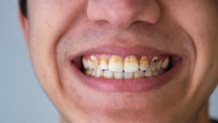 दातांवर साचलेला पिवळा थर मिनिटांमध्ये होईल गायब! स्वयंपाक घरातील ‘हे’ पदार्थ ठरतील प्रभावी, अंधारातही चमकतील दात