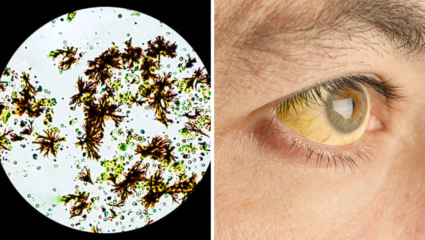 How To Remove Bilirubin: सडलेले लिव्हर, डोळ्यात कावीळ; घातक विष आहे बिलीरूबीन, 5 पद्धतीने शरीराबाहेर फेका पिवळा कचरा